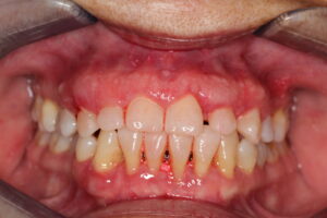 1. crown lengthning pre op