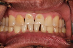 1. veneers pre op