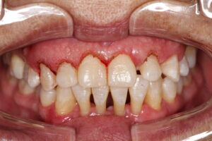 2. crown lengthning surgery
