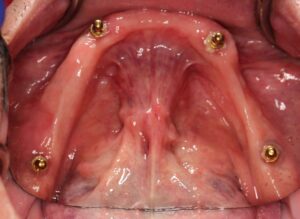 2. overdenture lower