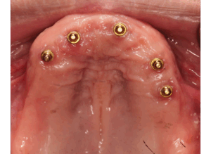 2. overdenture lower
