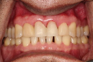 2. veneers provisionals