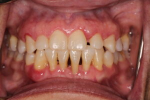 3. crown lengthning post op