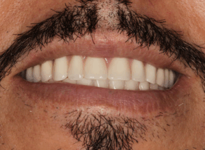 3. overdenture delivery 2