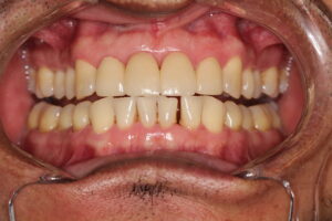 3. veneers delivery