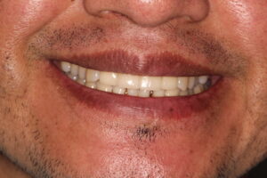 4. veneers delivery